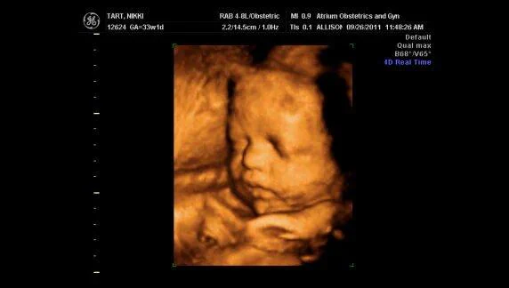 УЗИ НА 33-Й НЕДЕЛЕ БЕРЕМЕННОСТИ / PREGMED.ORG
